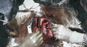 TG Kommas - Heart Surgery